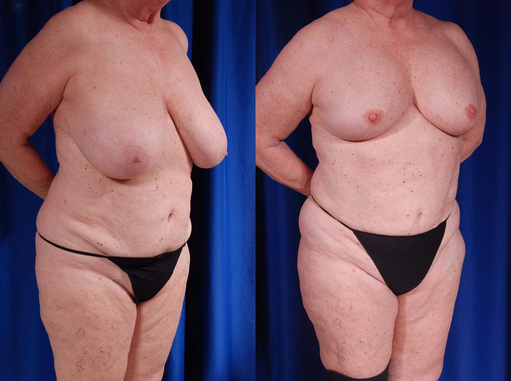 Breast Reconstruction Before And After Pictures Case 124 Metairie And