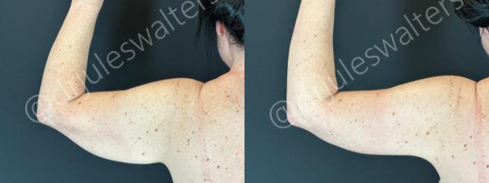 Before & After Arm Lift (Brachioplasty) Case 178 Left Arm Back View in Metairie and New Orleans, LA