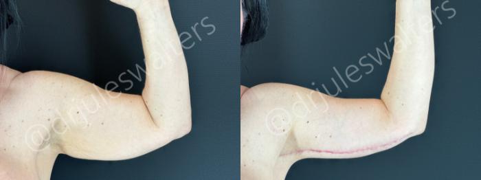 Before & After Arm Lift (Brachioplasty) Case 178 Left Arm Front View in Metairie and New Orleans, LA