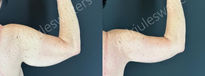 Before & After Arm Lift (Brachioplasty) Case 178 Right Arm Back View in Metairie and New Orleans, LA