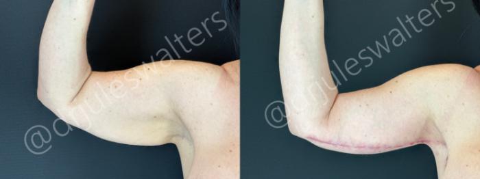 Before & After Arm Lift (Brachioplasty) Case 178 Right Arm Front View in Metairie and New Orleans, LA