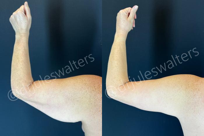 Before & After Arm Lift (Brachioplasty) Case 196 Left Side View in Metairie and New Orleans, LA