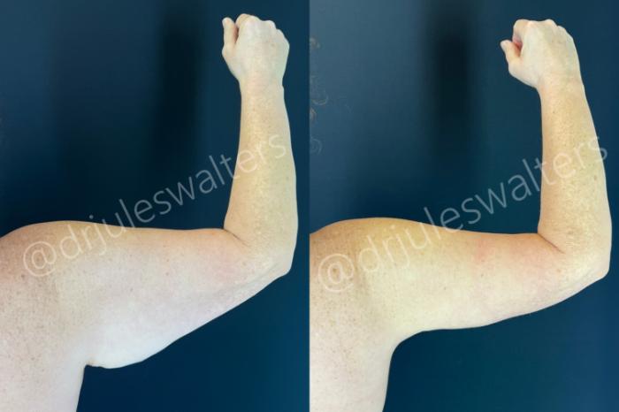 Before & After Arm Lift (Brachioplasty) Case 196 Right Side View in Metairie and New Orleans, LA