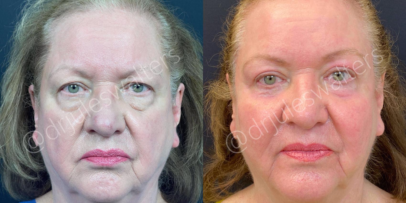 Before & After Blepharoplasty Case 131 View #1 View in Metairie, New Orleans, Covington, LA