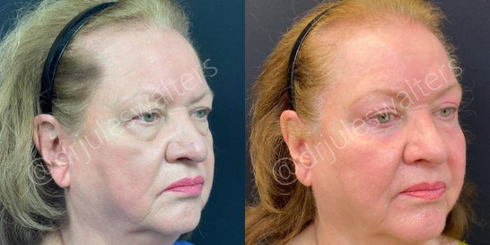 Before & After Blepharoplasty Case 131 View #2 View in Metairie and New Orleans, LA