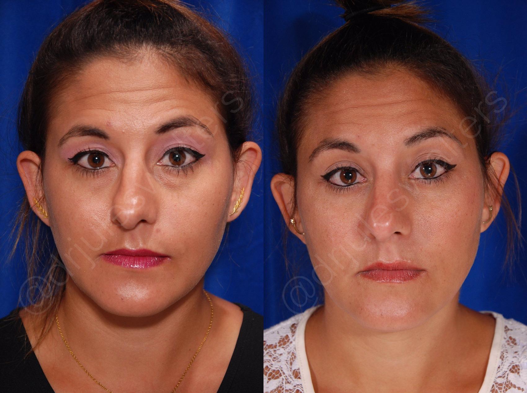 Before & After Blepharoplasty Case 132 View #1 View in Metairie, New Orleans, Covington, LA
