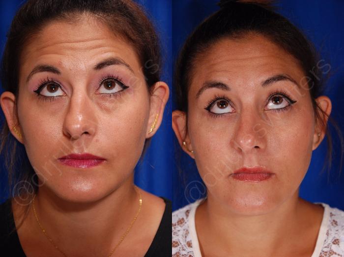 Before & After Blepharoplasty Case 132 View #2 View in Metairie and New Orleans, LA