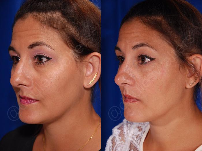 Before & After Blepharoplasty Case 132 View #3 View in Metairie and New Orleans, LA