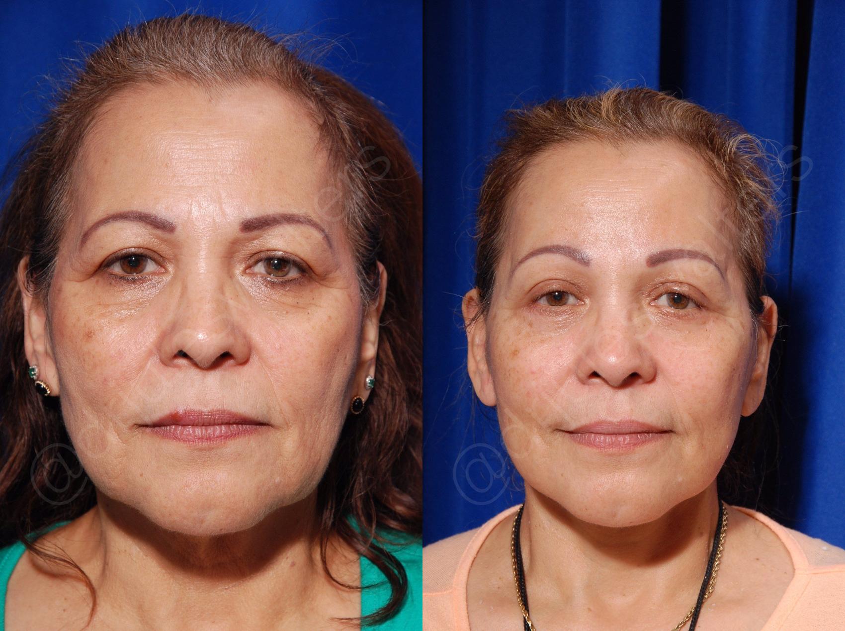 Before & After Blepharoplasty Case 133 View #1 View in Metairie and New Orleans, LA