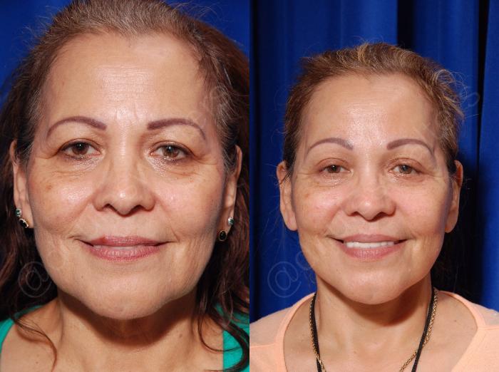Before & After Brow Lift Case 133 View #2 View in Metairie and New Orleans, LA