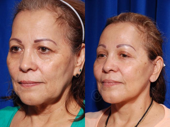 Before & After Blepharoplasty Case 133 View #3 View in Metairie and New Orleans, LA