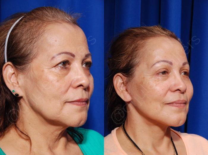 Before & After Blepharoplasty Case 133 View #4 View in Metairie and New Orleans, LA