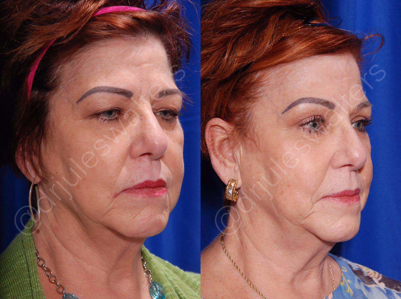 Before & After Blepharoplasty Case 134 View #1 View in Metairie, New Orleans, Covington, LA