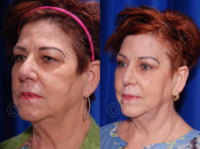 Before & After Brow Lift Case 134 View #2 View in Metairie and New Orleans, LA