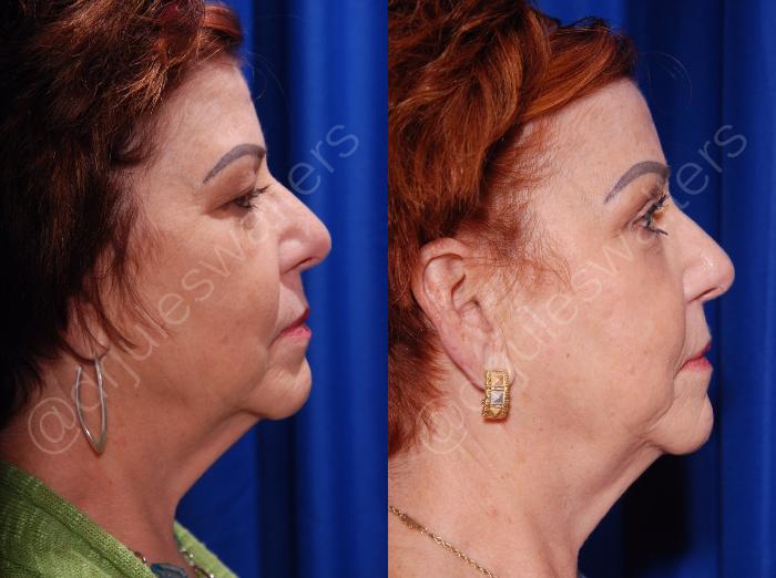 Before & After Blepharoplasty Case 134 View #3 View in Metairie and New Orleans, LA