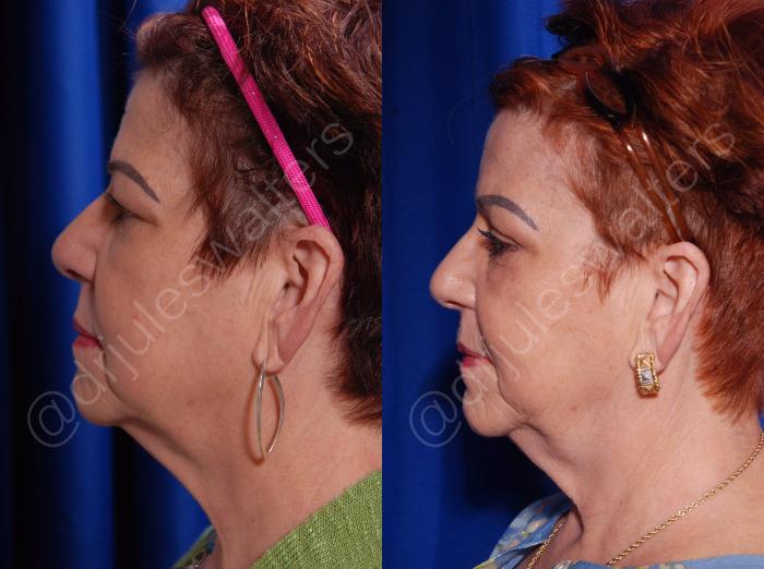 Before & After Blepharoplasty Case 134 View #4 View in Metairie and New Orleans, LA