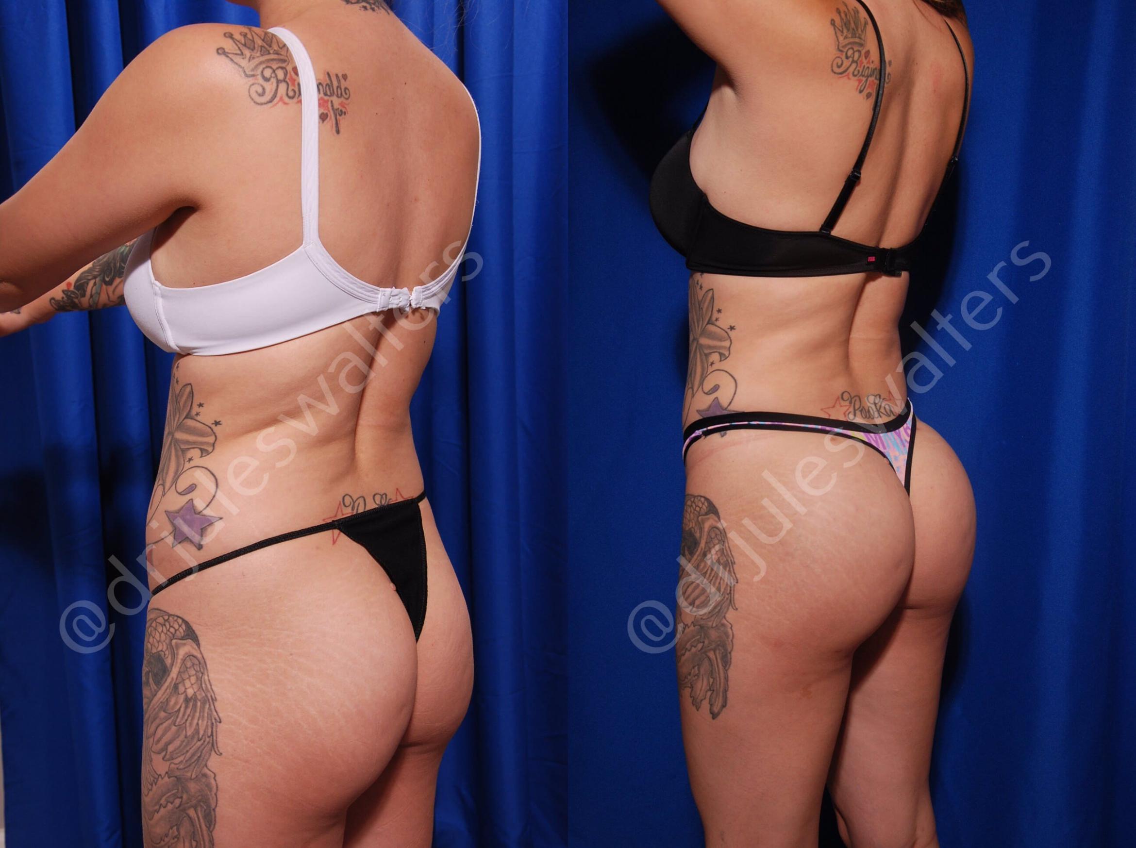 Before & After Body Contouring Case 10 View #1 View in Metairie, New Orleans, Covington, LA