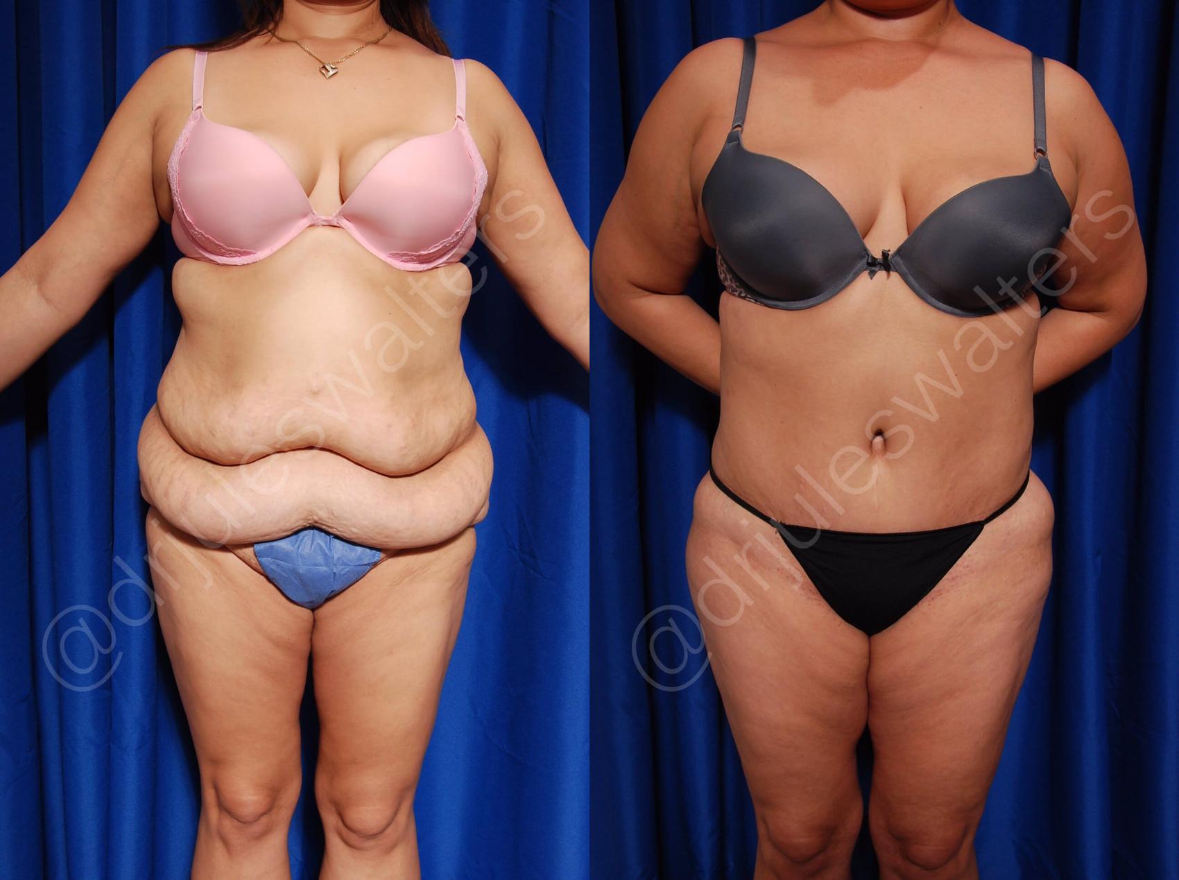 Before & After Body Contouring Case 2 View #1 View in Metairie, New Orleans, Covington, LA