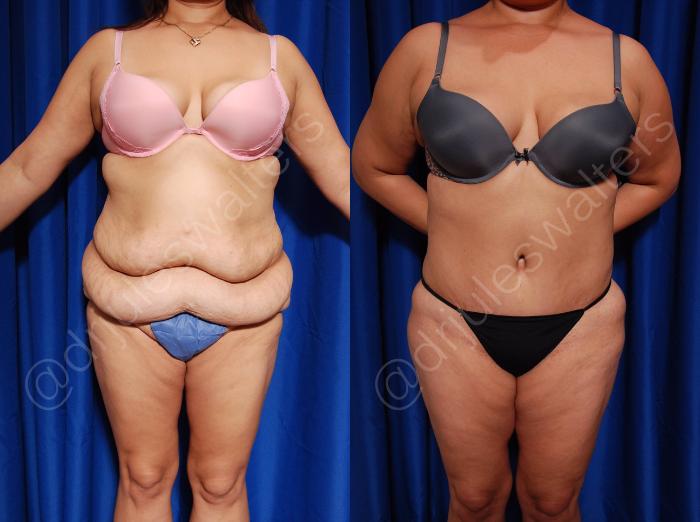 Before & After Tummy Tuck Case 2 View #1 View in Metairie and New Orleans, LA