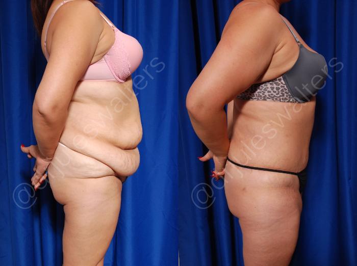 Before & After Tummy Tuck Case 2 View #2 View in Metairie and New Orleans, LA
