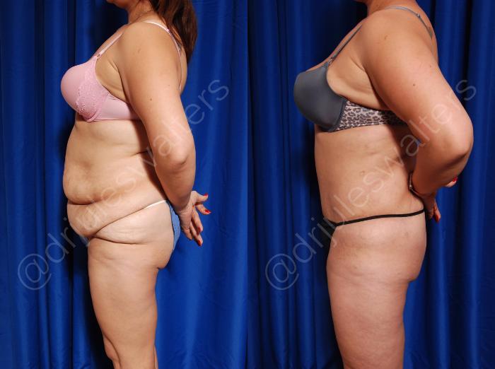 Before & After Body Contouring Case 2 View #3 View in Metairie and New Orleans, LA