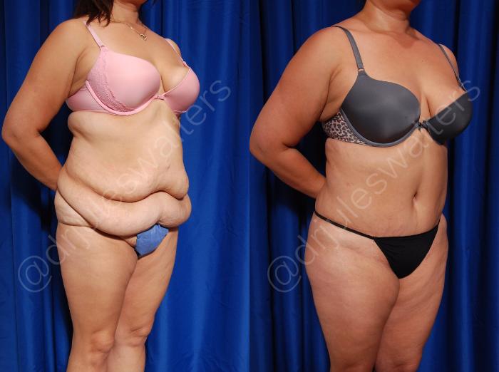 Before & After Body Contouring Case 2 View #4 View in Metairie and New Orleans, LA