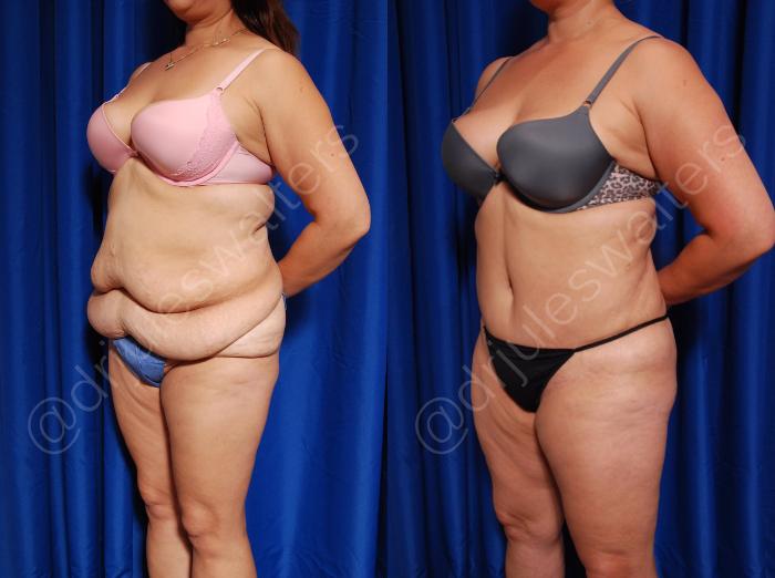 Before & After Tummy Tuck Case 2 View #5 View in Metairie and New Orleans, LA