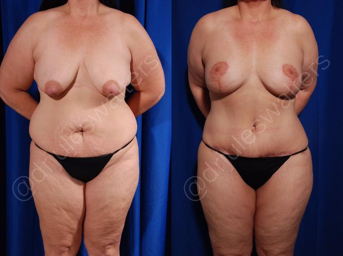 Before & After Tummy Tuck Case 3 View #1 View in Metairie and New Orleans, LA