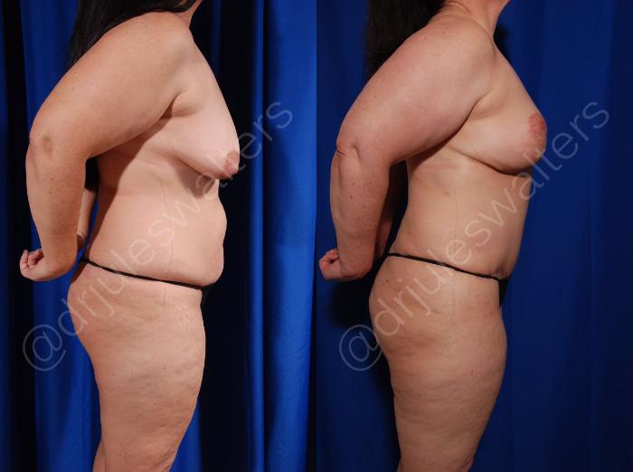 Before & After Tummy Tuck Case 3 View #2 View in Metairie and New Orleans, LA