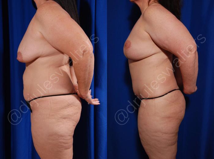 Before & After Tummy Tuck Case 3 View #3 View in Metairie and New Orleans, LA