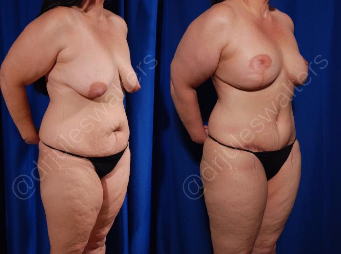 Before & After Tummy Tuck Case 3 View #4 View in Metairie and New Orleans, LA