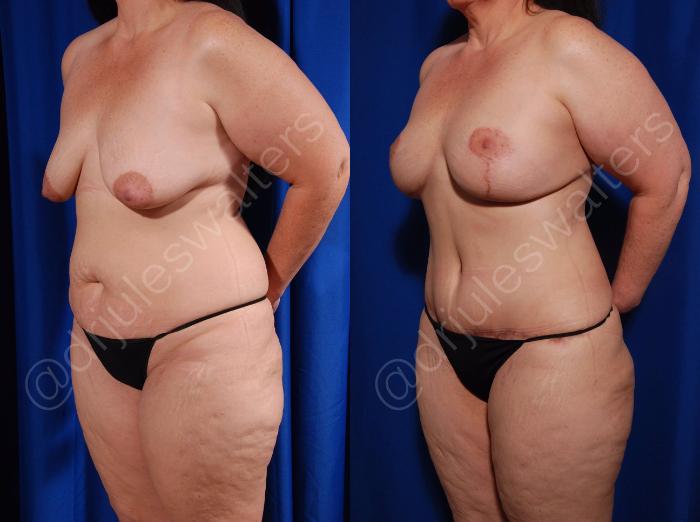 Before & After Tummy Tuck Case 3 View #5 View in Metairie and New Orleans, LA