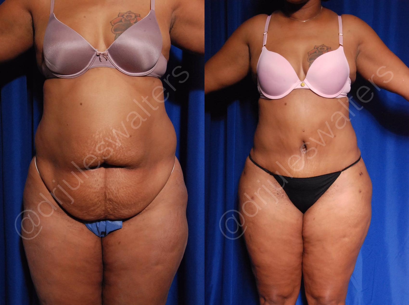 Before & After Body Contouring Case 5 View #1 View in Metairie, New Orleans, Covington, LA