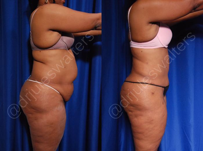Before & After Tummy Tuck Case 5 View #2 View in Metairie and New Orleans, LA