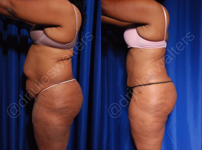 Before & After Tummy Tuck Case 5 View #3 View in Metairie and New Orleans, LA