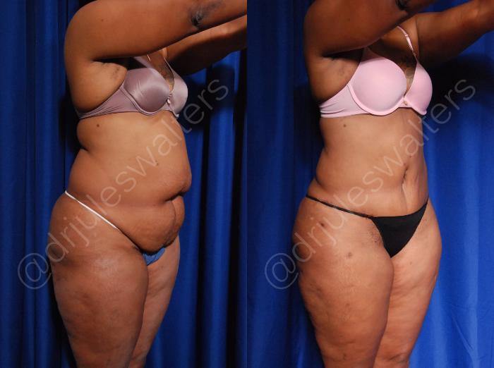 Before & After Tummy Tuck Case 5 View #4 View in Metairie and New Orleans, LA