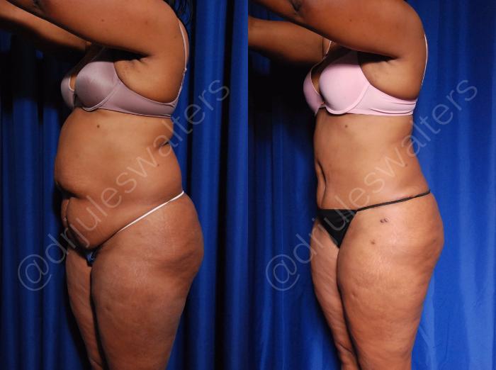 Before & After Liposuction Case 5 View #5 View in Metairie and New Orleans, LA