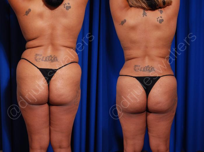 Before & After Body Contouring Case 6 View #1 View in Metairie and New Orleans, LA