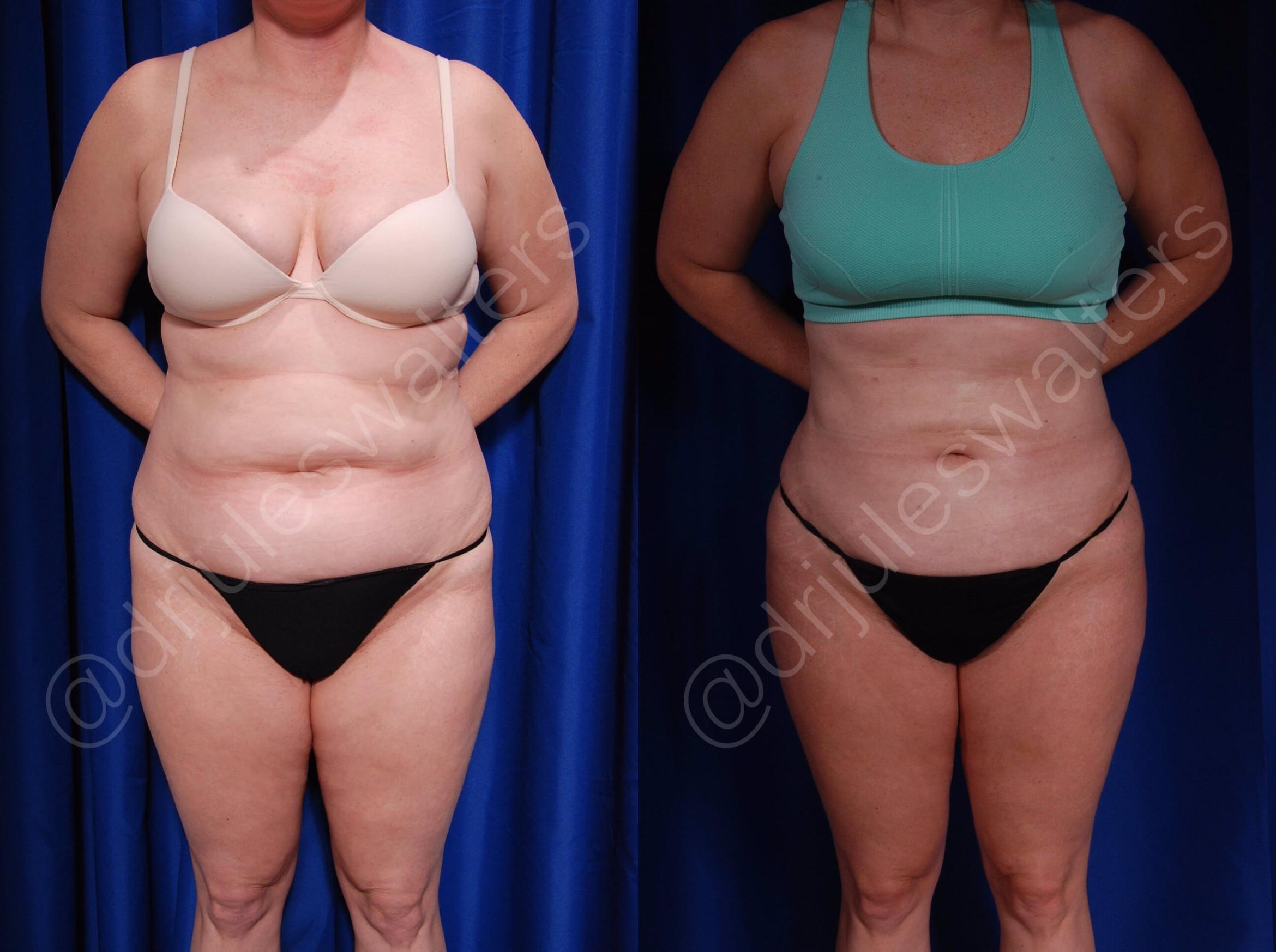 Before & After Body Contouring Case 7 View #1 View in Metairie, New Orleans, Covington, LA