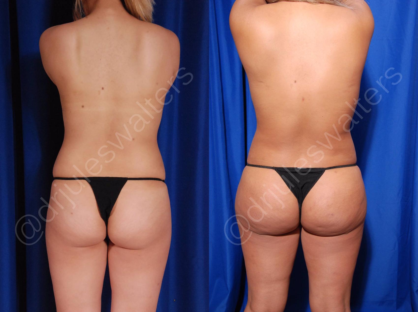 Before & After Body Contouring Case 9 View #1 View in Metairie, New Orleans, Covington, LA