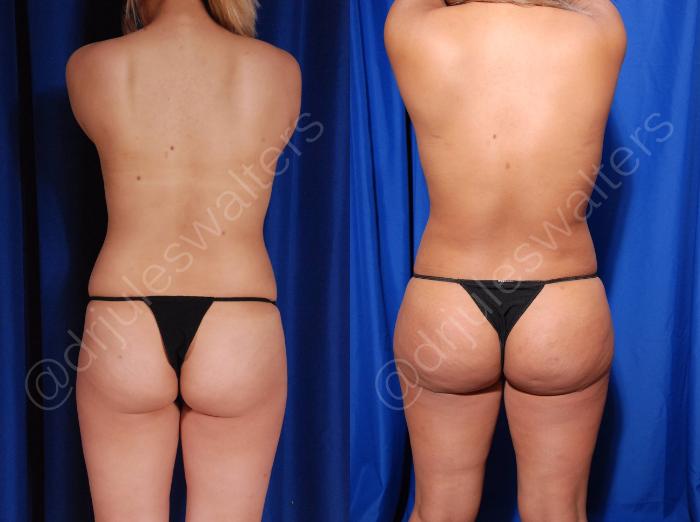 Before & After Liposuction Case 9 View #1 View in Metairie and New Orleans, LA