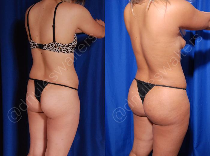 Before & After Brazilian Butt Lift Case 9 View #2 View in Metairie and New Orleans, LA