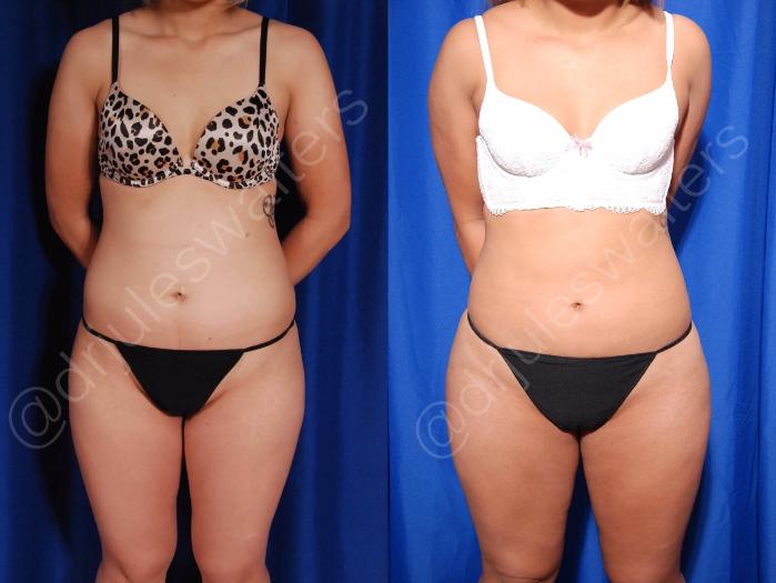 Before & After Brazilian Butt Lift Case 9 View #4 View in Metairie and New Orleans, LA