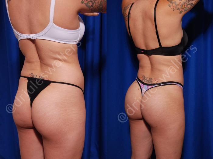 Before & After Liposuction Case 10 View #2 View in Metairie and New Orleans, LA