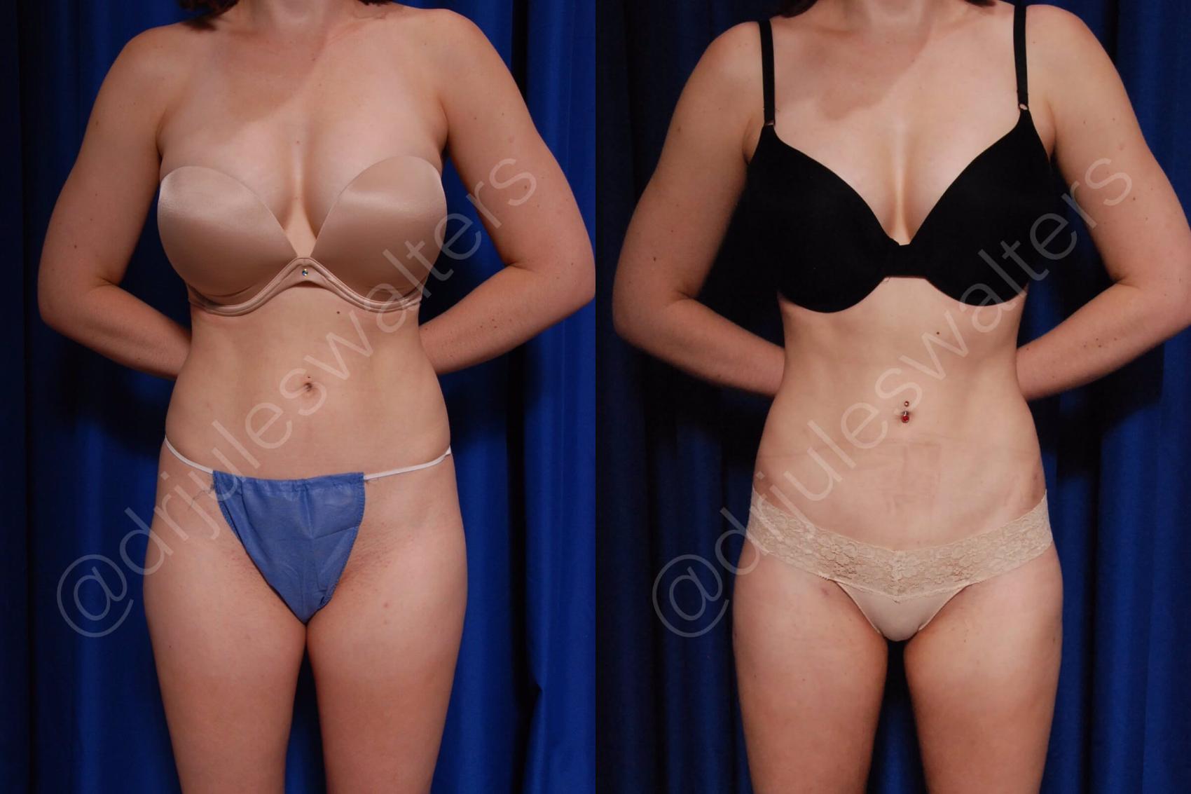 Before & After Brazilian Butt Lift Case 11 View #2 View in Metairie and New Orleans, LA