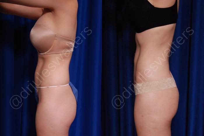 Before & After Body Contouring Case 11 View #3 View in Metairie and New Orleans, LA