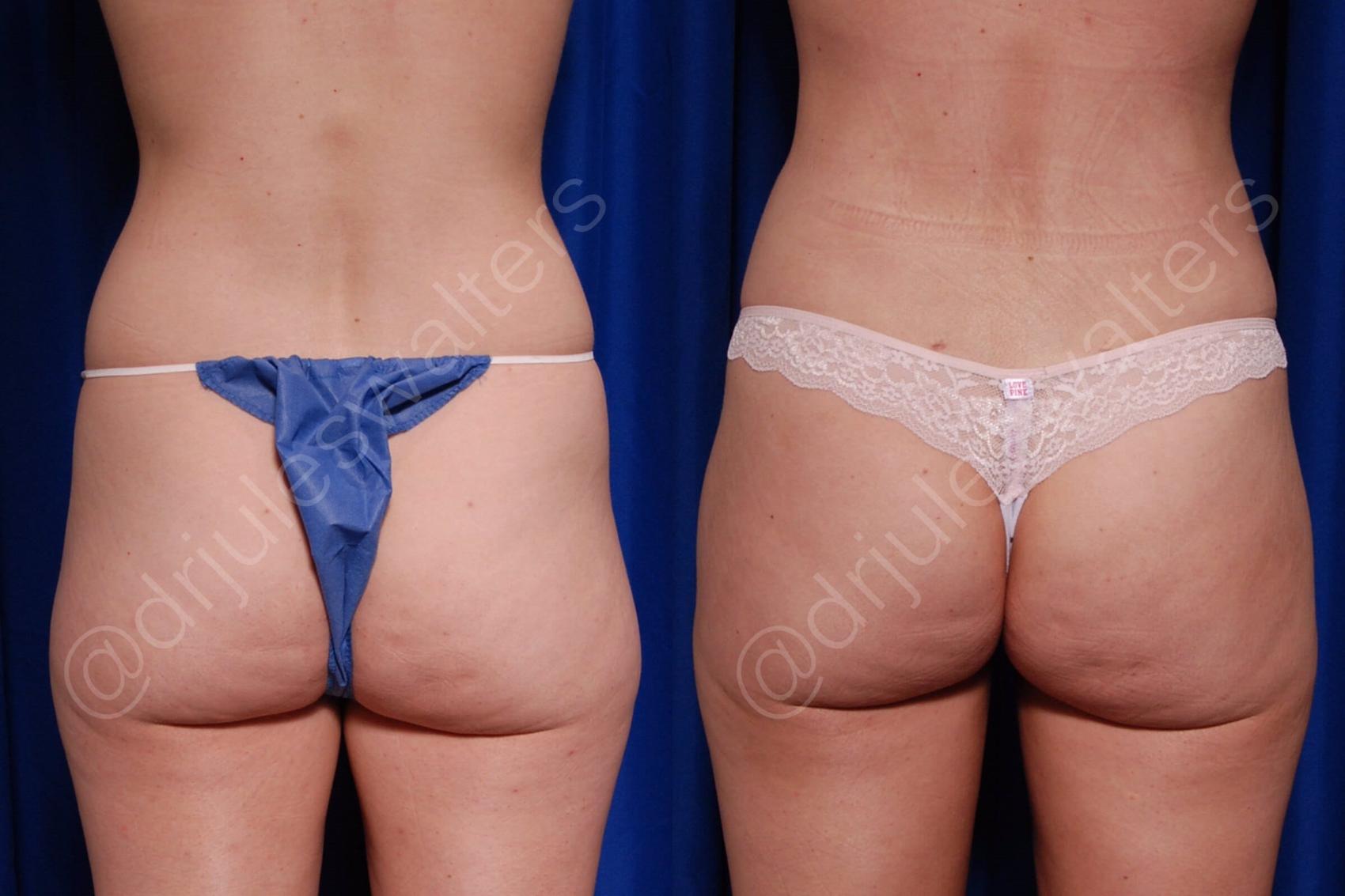 Before & After Brazilian Butt Lift Case 11 View #5 View in Metairie and New Orleans, LA