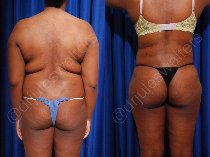 Before & After Brazilian Butt Lift Case 12 View #1 View in Metairie and New Orleans, LA