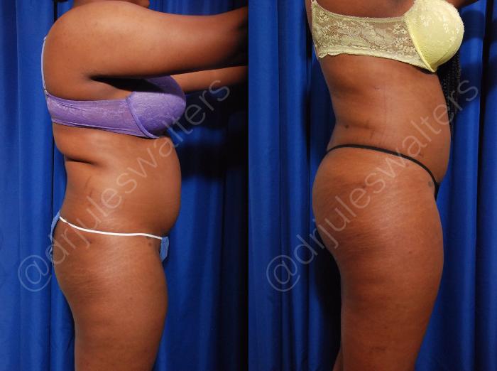Before & After Liposuction Case 12 View #2 View in Metairie and New Orleans, LA