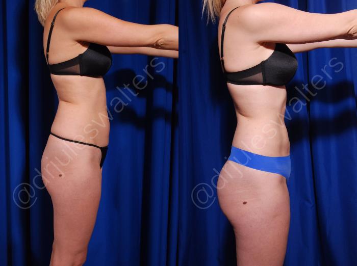 Before & After Liposuction Case 13 View #1 View in Metairie and New Orleans, LA